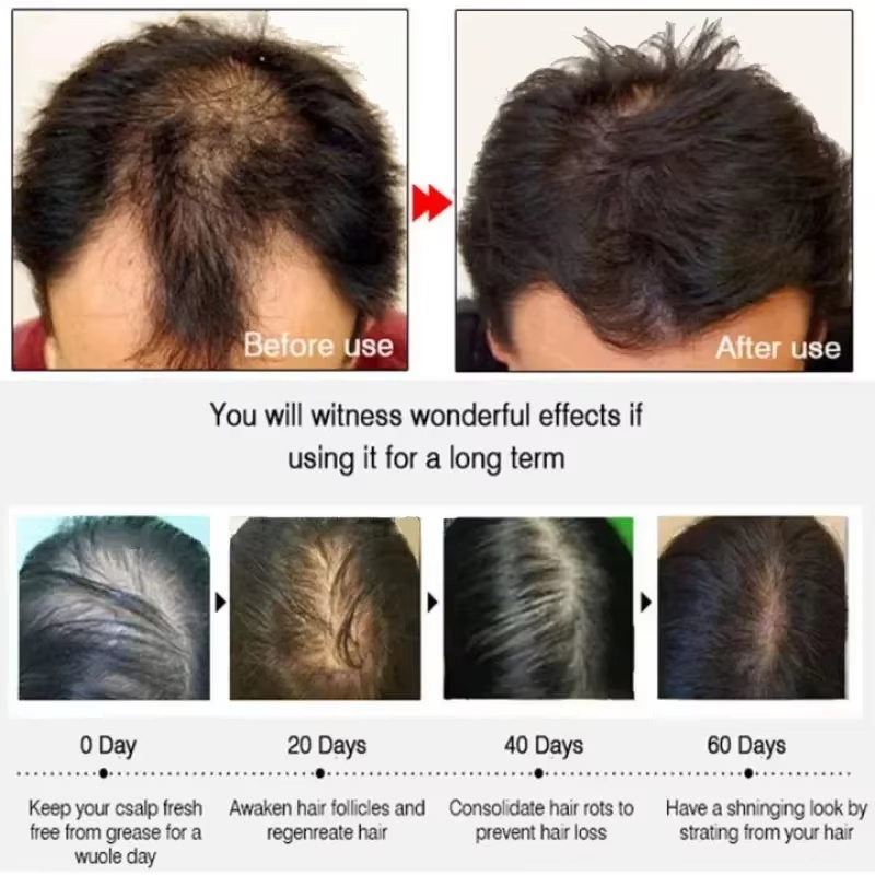 Sérum de croissance des cheveu - Hair Care Elseve avis et prix